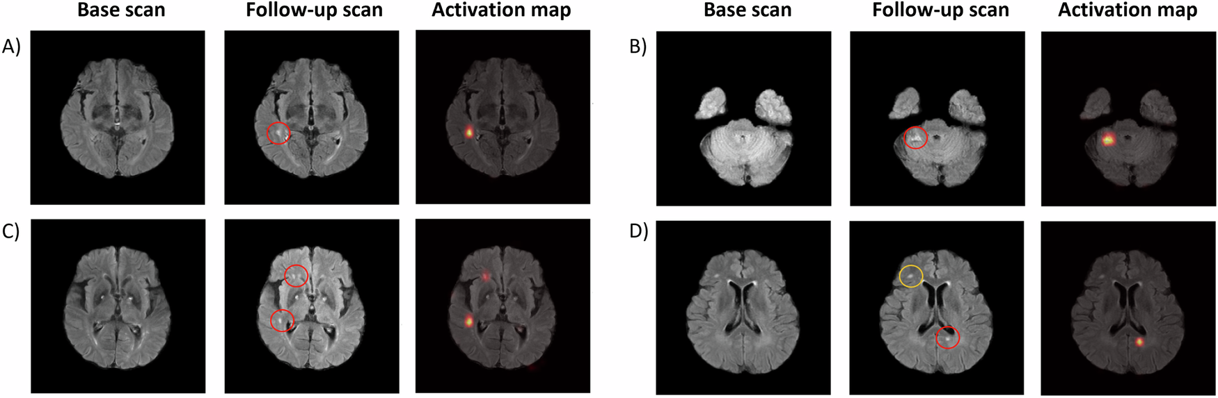 초기 및 추적 MRI에서 새롭게 발생한 뇌경색 병변과 인공지능 모델의 탐지 결과를 비교한 예시 (출처: Cho et al., npj Digital Medicine, 2026, CC BY-NC-ND 4.0)